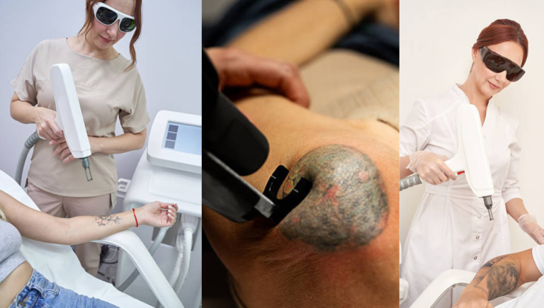 Pete Davidson Shares on “Awful” Tattoo Removal Process:Complete guide to know Pete Davidson Shares on “Awful” Tattoo Removal Process:Complete guide to know